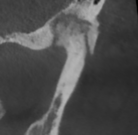 Сустав с артрозом: ВНЧС больной 2.png