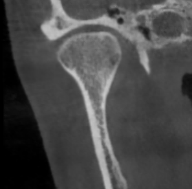 Здоровый сустав: ВНЧС норм 2.png