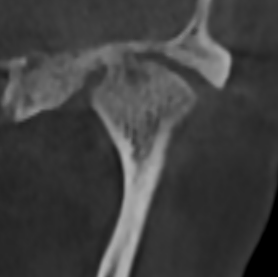 Сустав с артрозом: ВНЧС больной 4.png