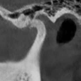 Сустав с артрозом: ВНЧС больной 5.png