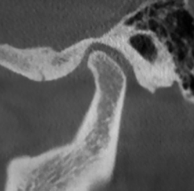 Здоровый сустав: ВНЧС норм 1.png